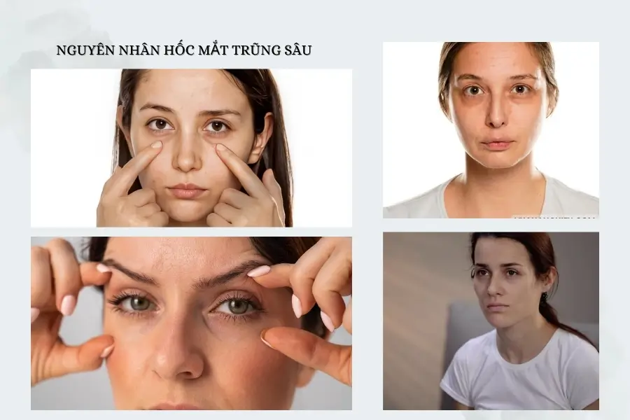 Nguyên nhân gây hốc mắt trũng sâu