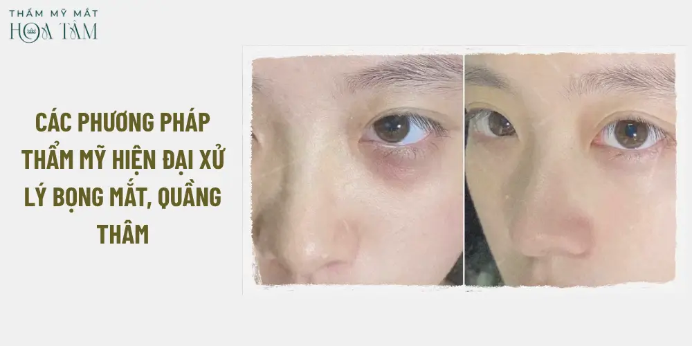 Các phương pháp thẩm mỹ hiện đại xử lý bọng mắt, quầng thâm