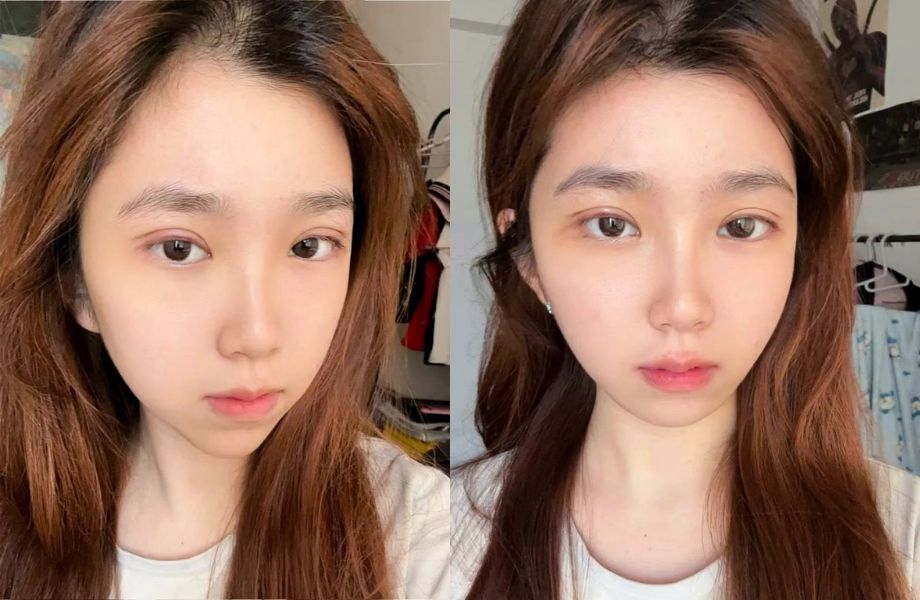 Đặc điểm mí mắt sau 6 tháng thẩm mỹ
