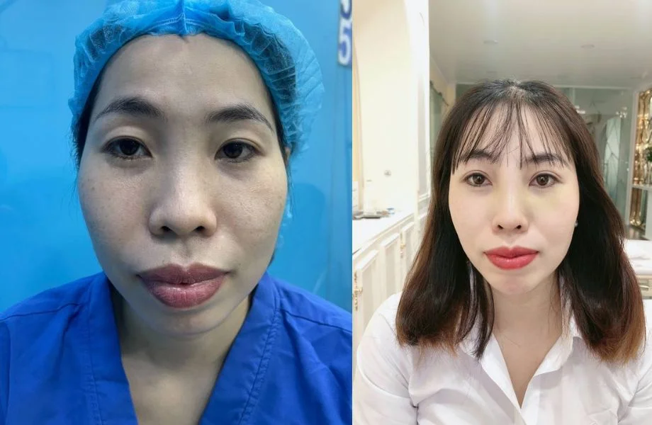 Chi phí cắt mí phượng hoàng giá bao nhiêu tiền
