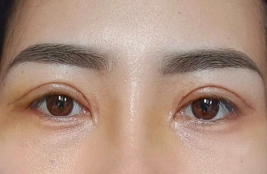 Lựa chọn dịch vụ cắt mí phượng hoàng
