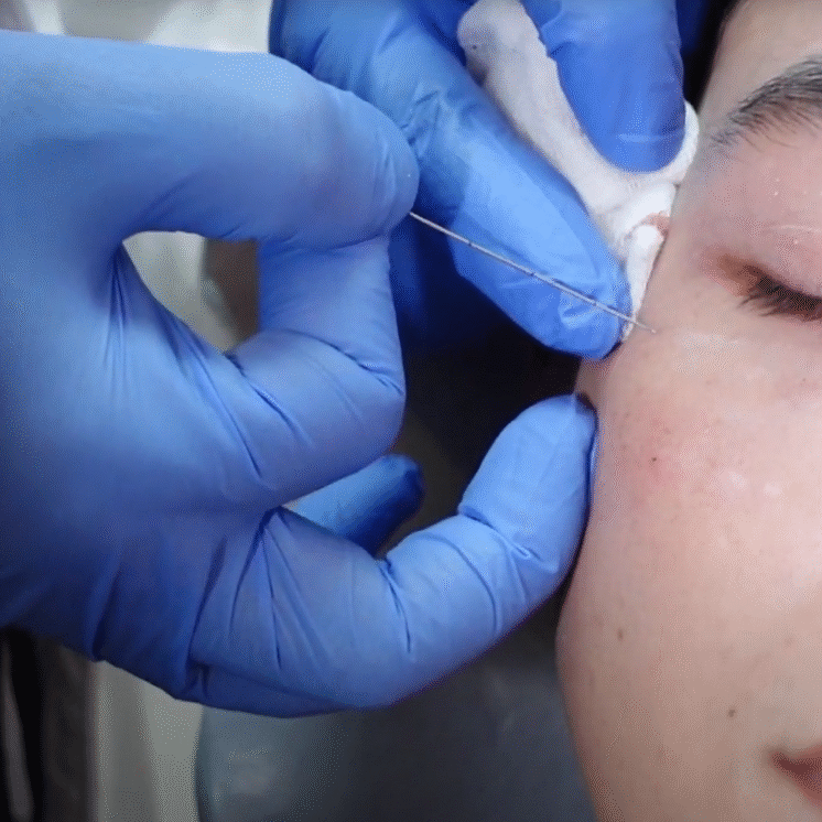 TIÊM COLLAGEN VÀO GÂN HỖ TRỢ ĐIỀU TRỊ TỔN THƯƠNG VÀ TĂNG CƯỜNG HOẠT ĐỘNG