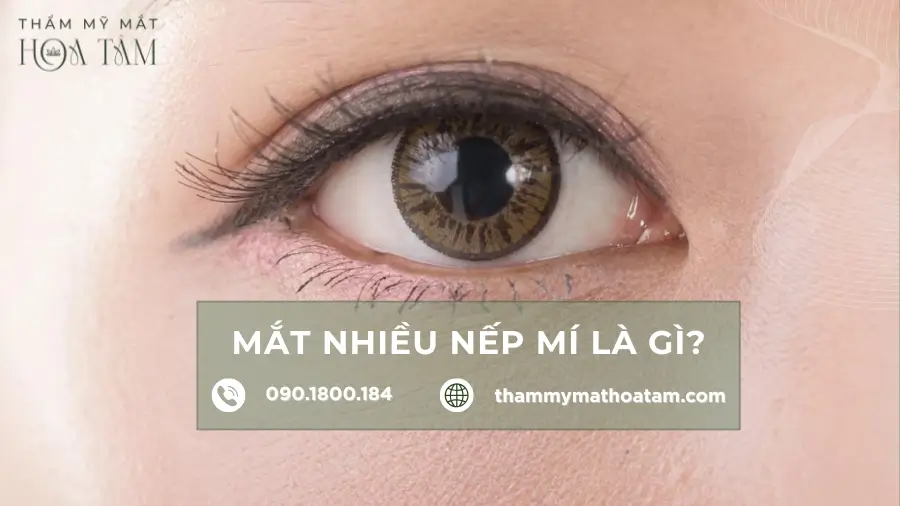 Mắt nhiều nếp mí là gì, dấu hiệu, nguyên nhân và điều trị