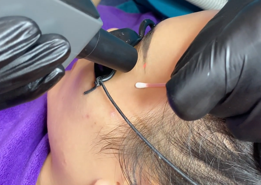 Hướng dẫn xóa laser lông mày bị đỏ an toàn, hiệu quả