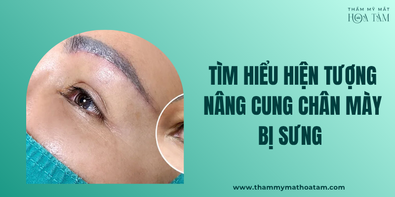 Khám phá hiện tượng nâng cung chân mày bị sưng