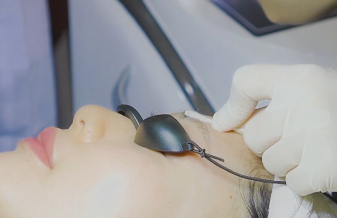 Nguyên nhân khiến lông mày trổ đỏ sau khi xóa laser