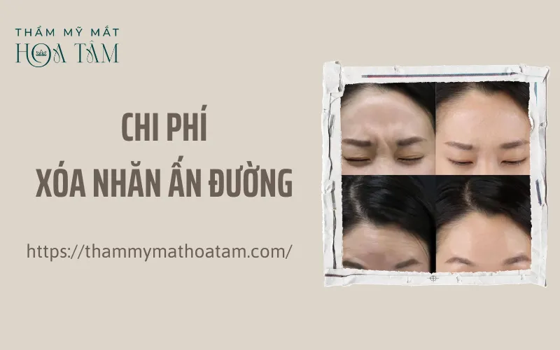 Mỗi phương pháp sẽ có chi phí xóa nhăn ấn đường khác nhau