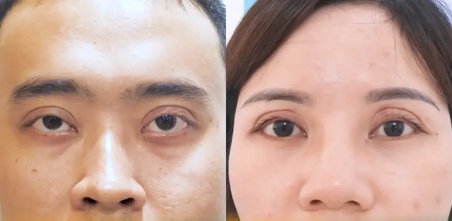 Giải thích về hiện tượng mắt bị trợn ngược Giải thích về hiện tượng mắt bị trợn ngược