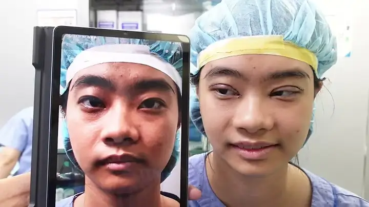 Quy trình thực hiện phẫu thuật chỉnh hình mắt xếch chuẩn y khoa