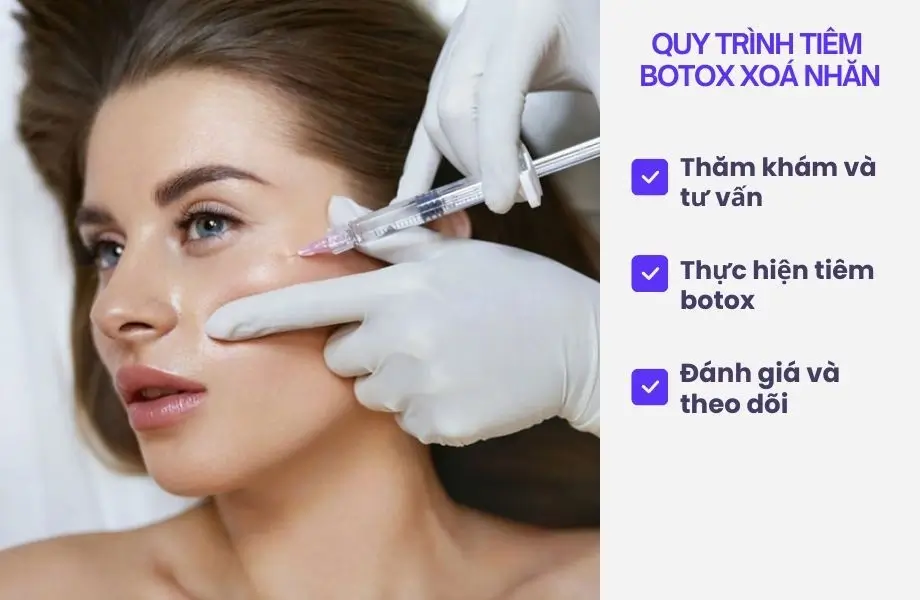 Quy trình tiêm botox xoá nhăn đuôi mắt