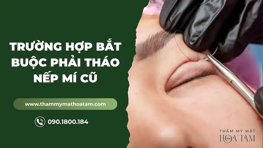 Những trường hợp nào khách hàng bắt buộc phải tháo nếp mí cũ?