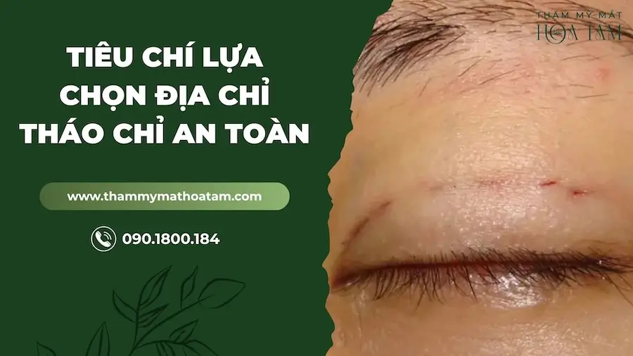 Tiêu chí lựa chọn địa chỉ tháo chỉ mí luồn an toàn