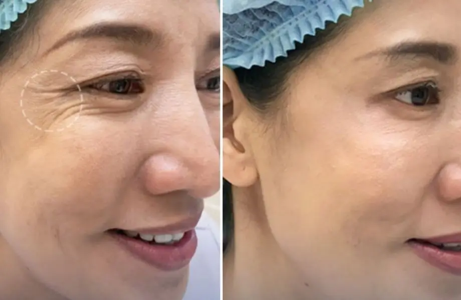 Tiêm botox xoá nhăn đuôi mắt giá bao nhiêu