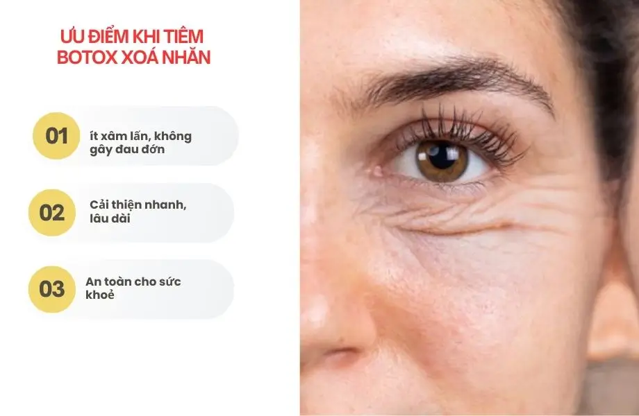 Ưu điểm khi tiêm botox xoá nhăn đuôi mắt