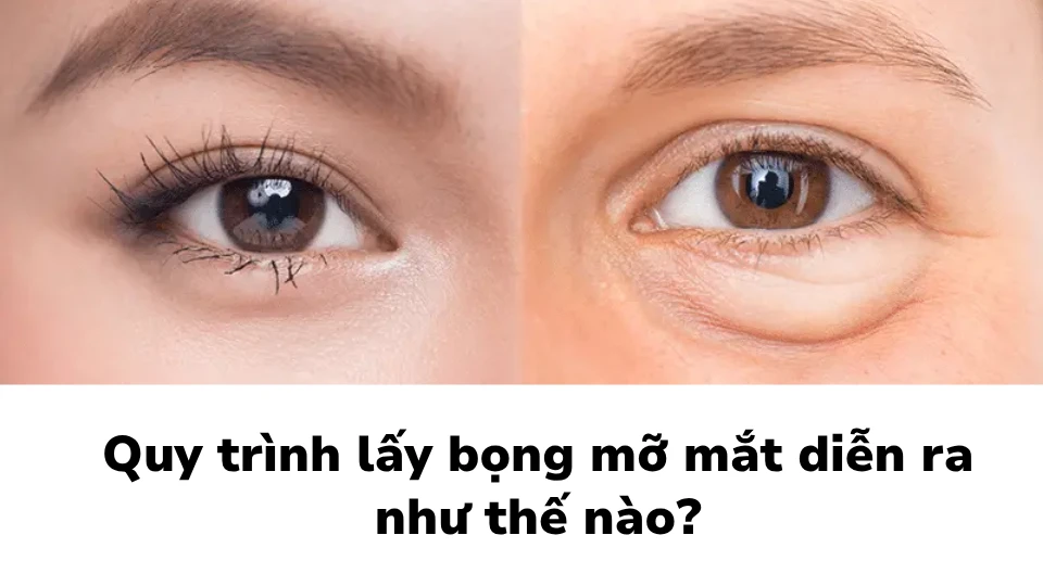 Quy trình lấy bọng mỡ mắt diễn ra như thế nào?