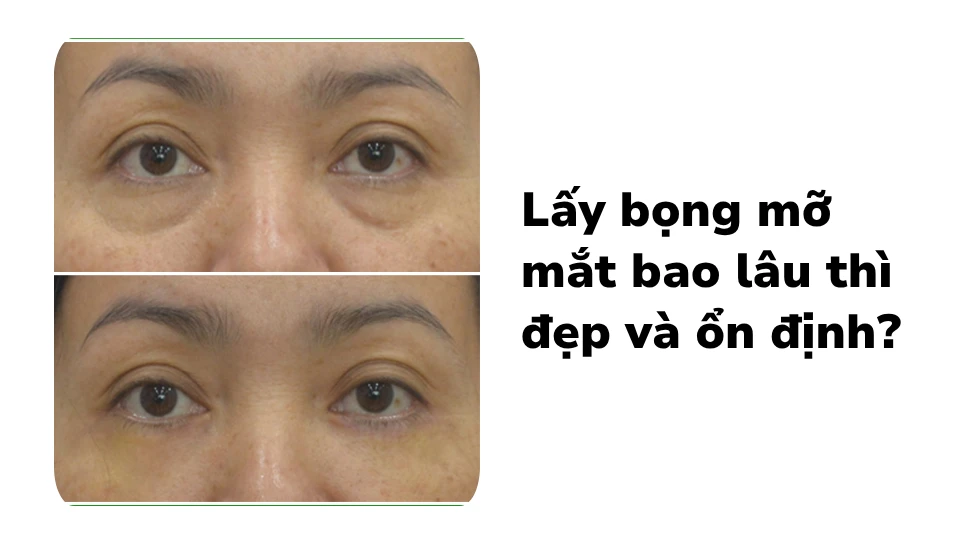 Lấy bọng mỡ mắt bao lâu thì đẹp và ổn định?