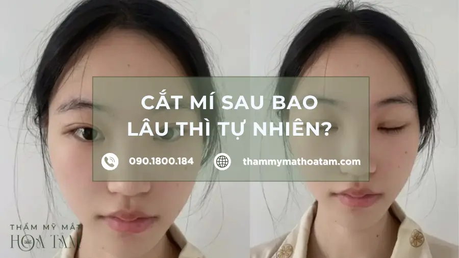 Cắt mí bao lâu đẹp tự nhiên, cách chăm sóc và hồi phục