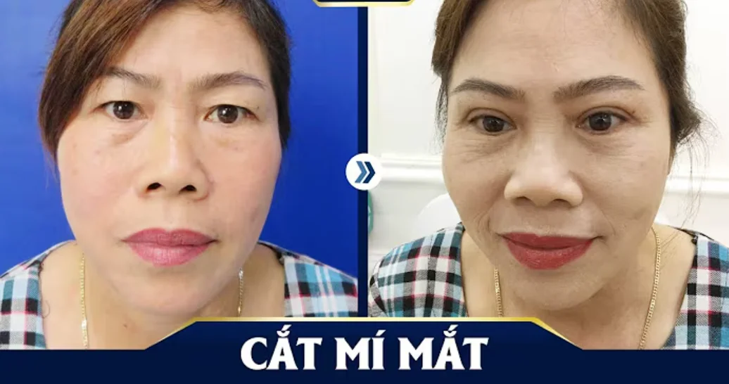 Dấu hiệu hồi phục tốt sau cắt mí 1 tháng
