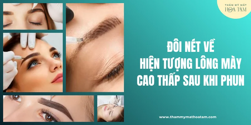 Đôi nét về hiện tượng lông mày cao thấp sau khi phun