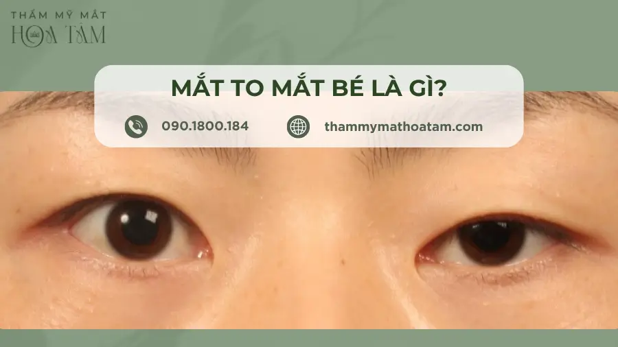 Mắt to mắt bé là gì, dấu hiệu, nguyên nhân và cách khắc phục