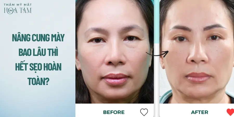 Nâng cung mày bao lâu thì hết sẹo hoàn toàn?