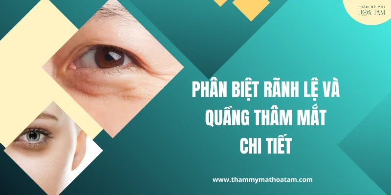 Phân biệt rãnh lệ là gì và quầng thâm mắt để tránh nhầm lẫn Phân biệt rãnh lệ là gì và quầng thâm mắt để tránh nhầm lẫn
