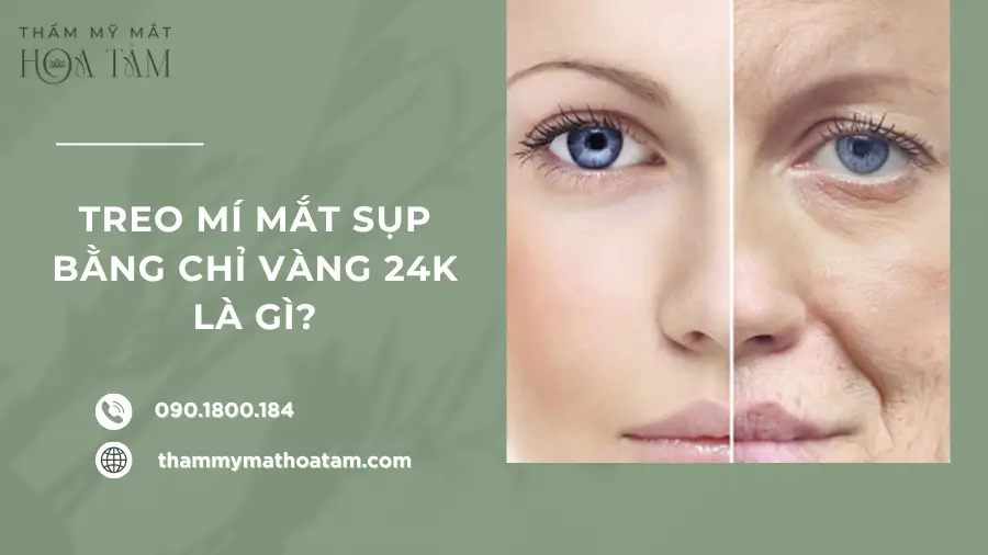 Treo mí mắt sụp bằng chỉ vàng