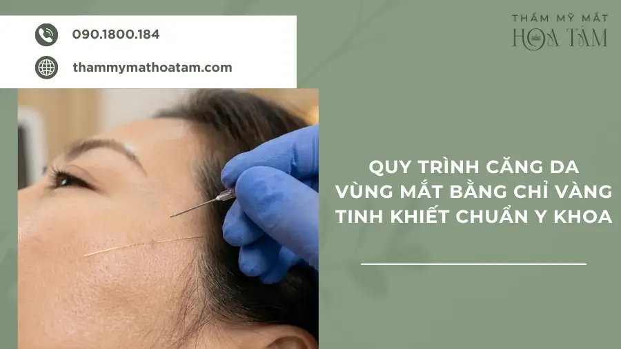 Quy trình treo mí mắt bằng chỉ vàng