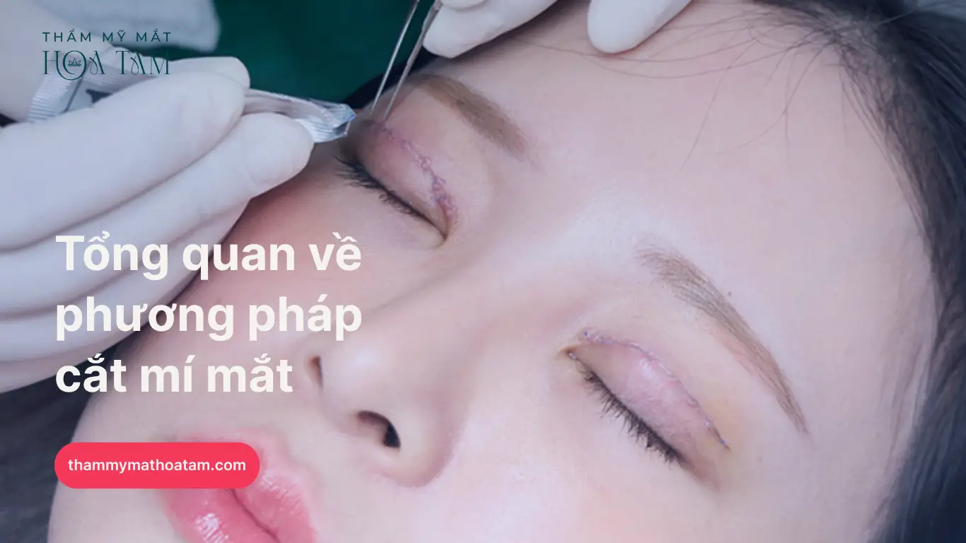 Tổng quan về phương pháp cắt mí mắt Tổng quan về phương pháp cắt mí mắt