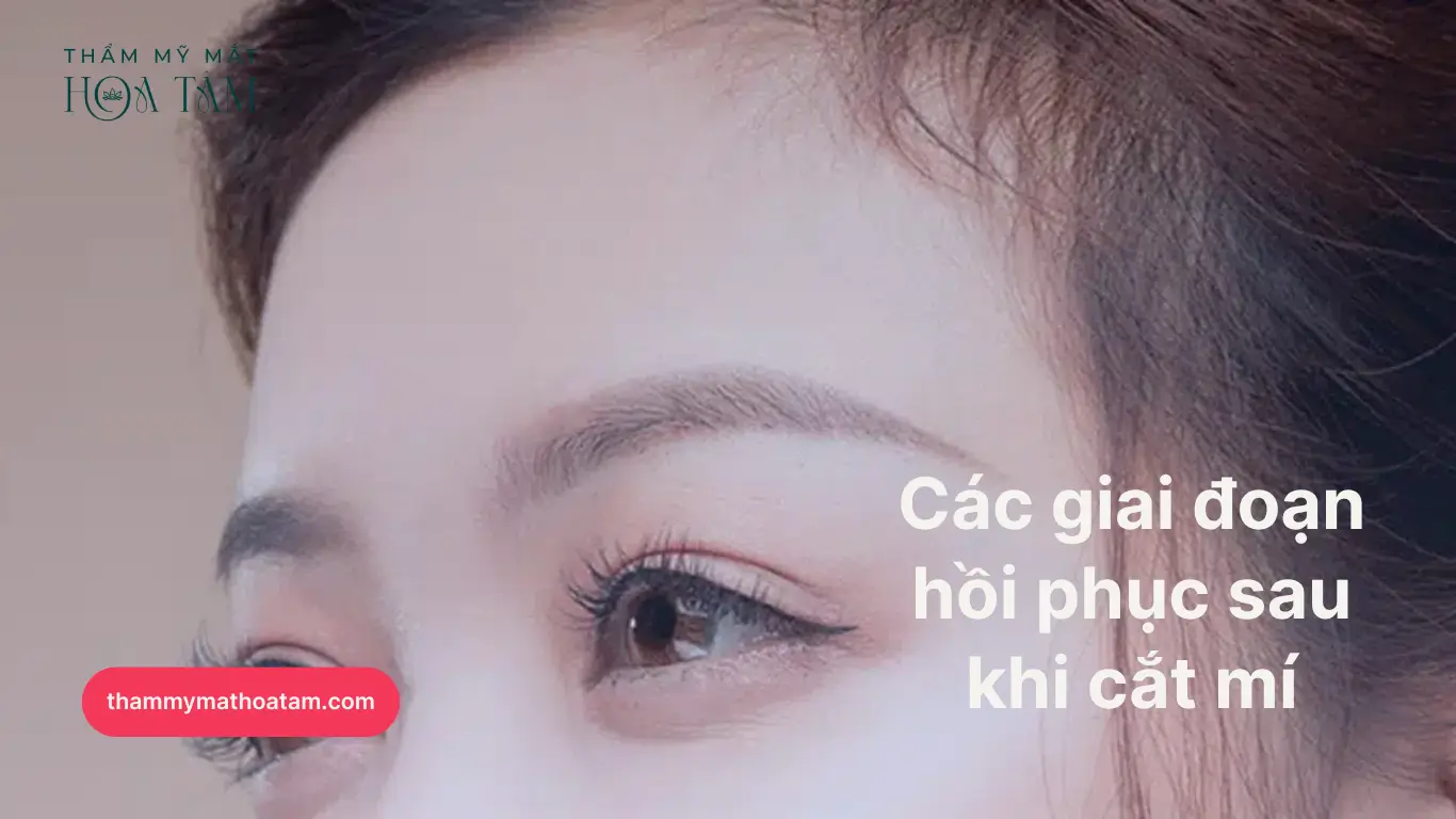 Các giai đoạn hồi phục sau khi cắt mí Các giai đoạn hồi phục sau khi cắt mí