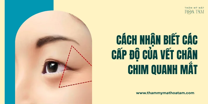 Cách nhận biết các cấp độ của vết chân chim quanh mắt