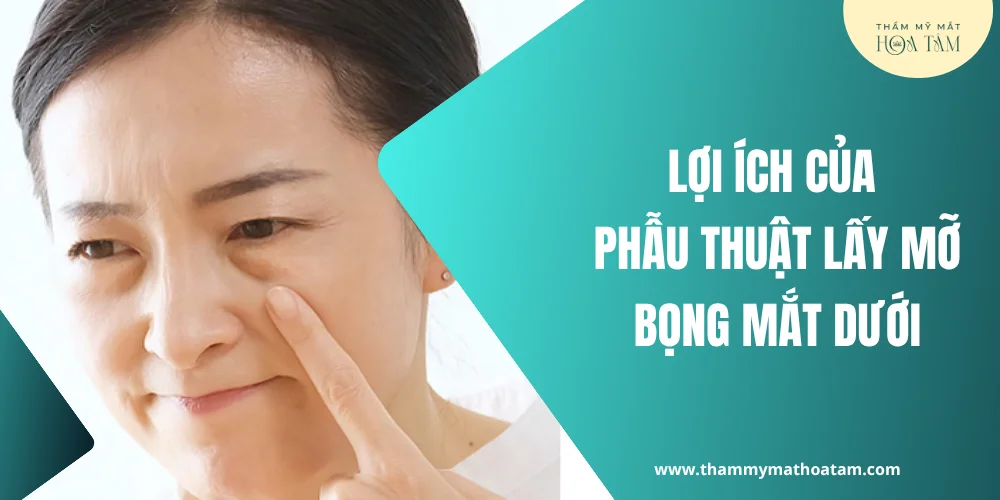 Lợi ích vượt trội của phẫu thuật lấy mỡ bọng mắt dưới