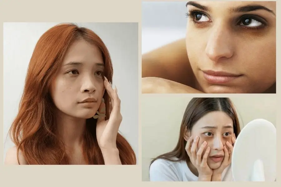 Nguyên nhân hình thành quầng thâm mắt bẩm sinh