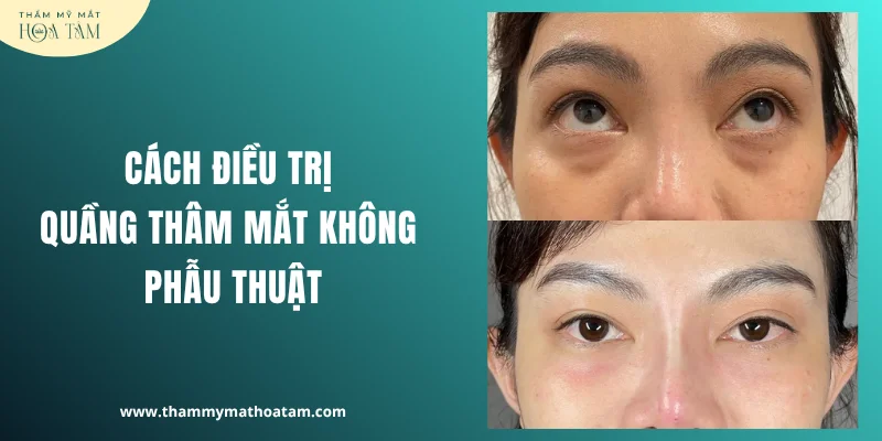 Cách điều trị quầng thâm mắt không phẫu thuật Cách điều trị quầng thâm mắt không phẫu thuật