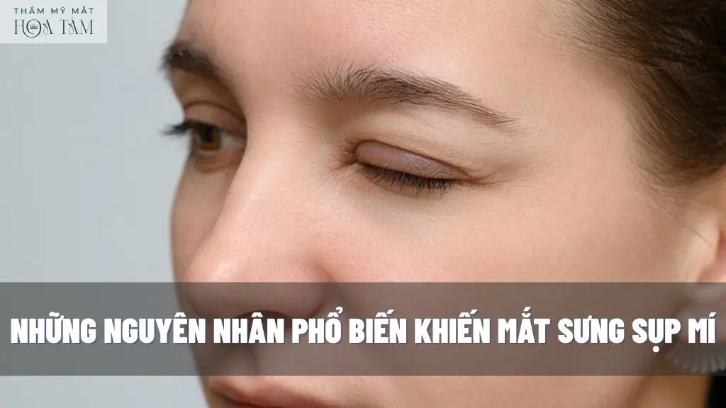 Những nguyên nhân phổ biến khiến mắt sưng sụp mí