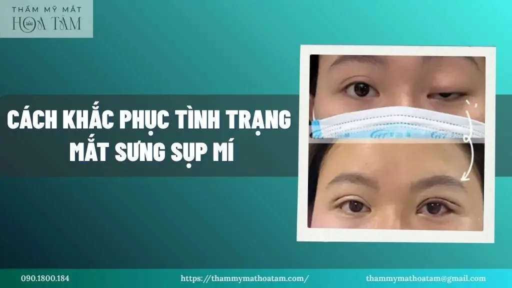Cách khắc phục tình trạng mắt sưng sụp mí
