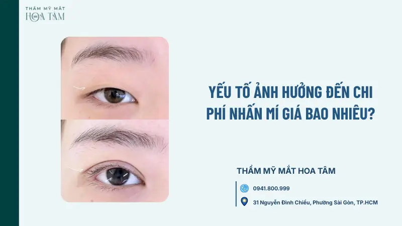 Yếu tố ảnh hưởng đến chi phí nhấn mí giá bao nhiêu?