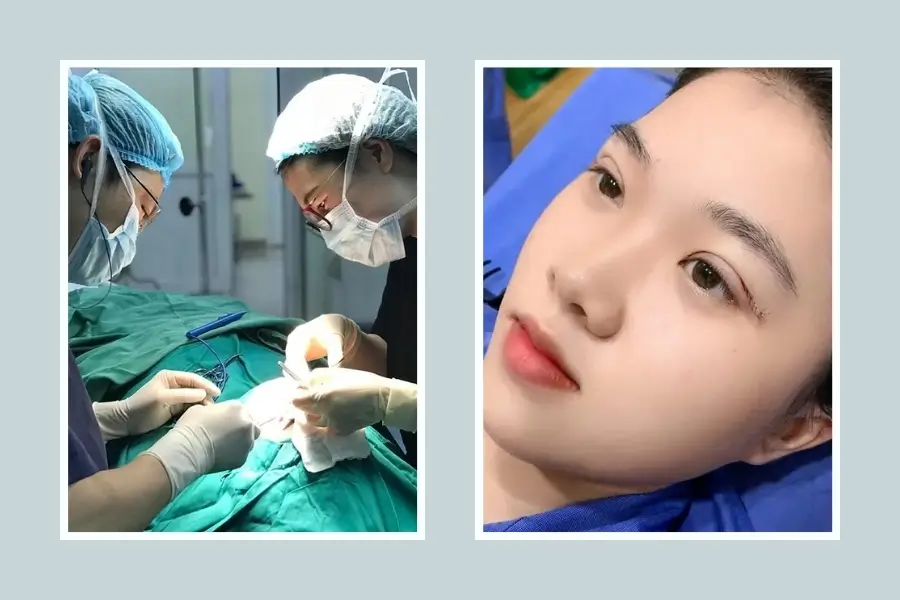 Cắt mí mắt và theo dõi sau hậu phẫu