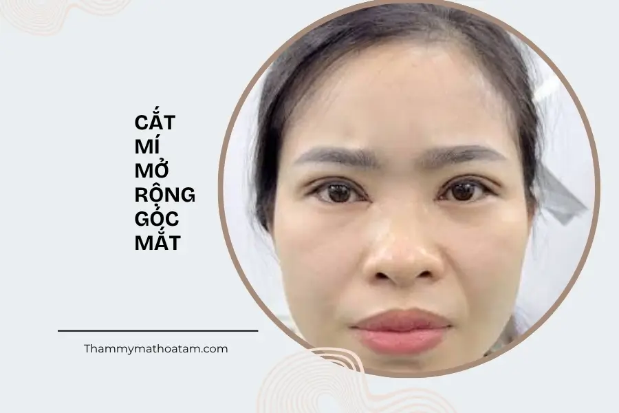 Cắt mí mở rộng góc mắt