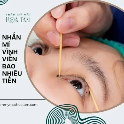 Nhấn mí vĩnh viễn bao nhiêu tiền