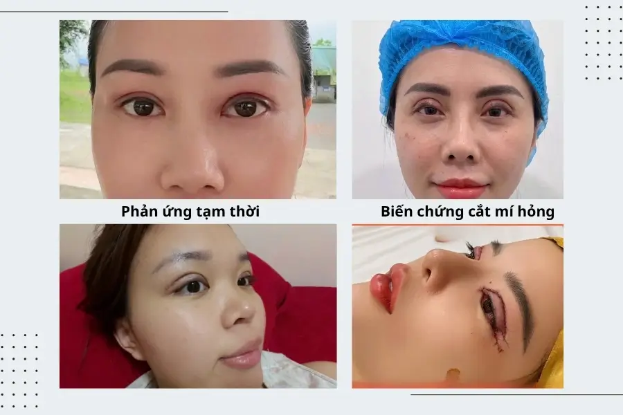 Phản ứng bình thường sau cắt mí và tác hại cắt mí mắt
