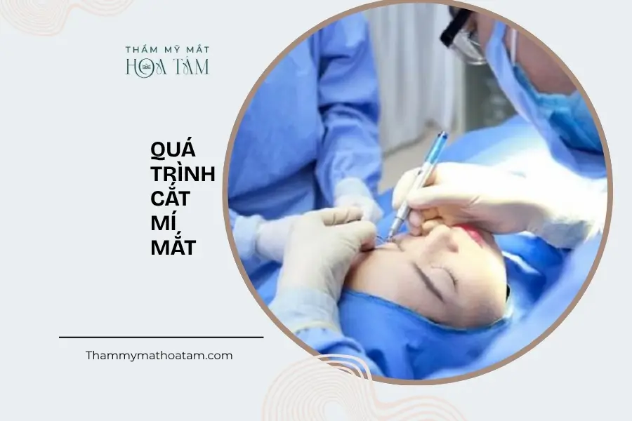 Quá trình cắt mí