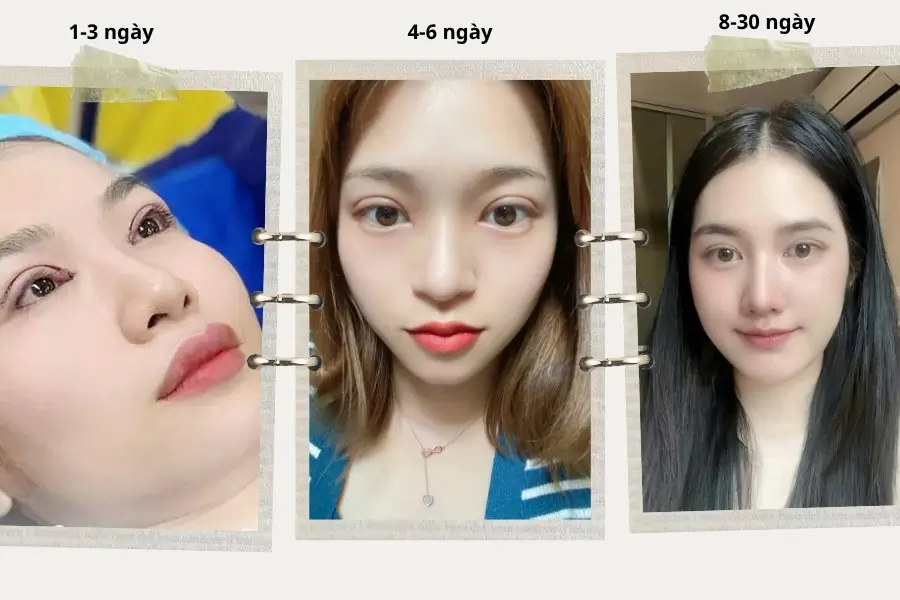 Tiến trình lành thương sau cắt mí mắt