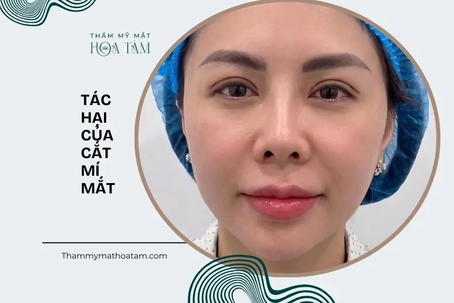 Cắt mí và tác hại của cắt mí mắt
