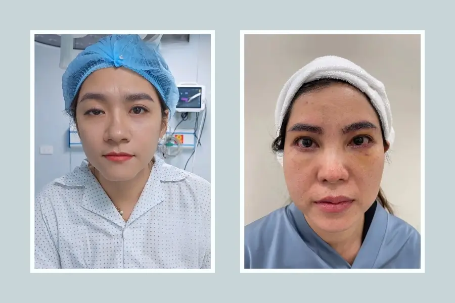 Tác hại của cắt mí mắt mất cân đối
