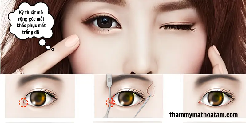 Kỹ thuật thẩm mỹ giúp cải thiện hình thái mắt trắng dã hiệu quả Kỹ thuật thẩm mỹ giúp cải thiện hình thái mắt trắng dã hiệu quả