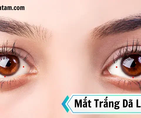 Đặc điểm đôi mắt trắng dã