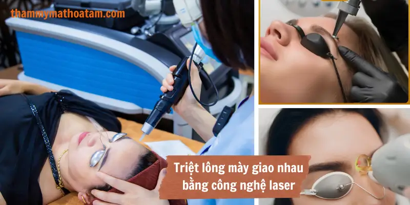 Triệt lông mày bằng laser hiệu quả, an toàn