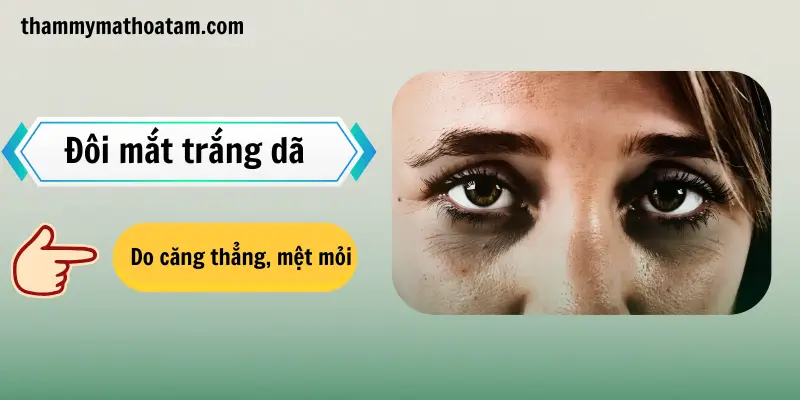 Người sở hữu đôi mắt trắng dã có thể do mệt mỏi, căng thẳng Người sở hữu đôi mắt trắng dã có thể do mệt mỏi, căng thẳng