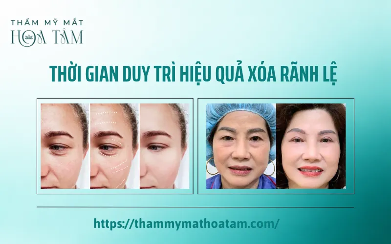 Mỗi phương pháp xóa rãnh lệ có thời gian duy trì khác nhau tùy kỹ thuật và cơ địa